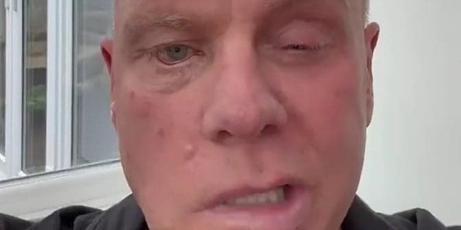 Andy Morrison otkriva borbu s teškom bolešću sindromom Ramsay Hunt